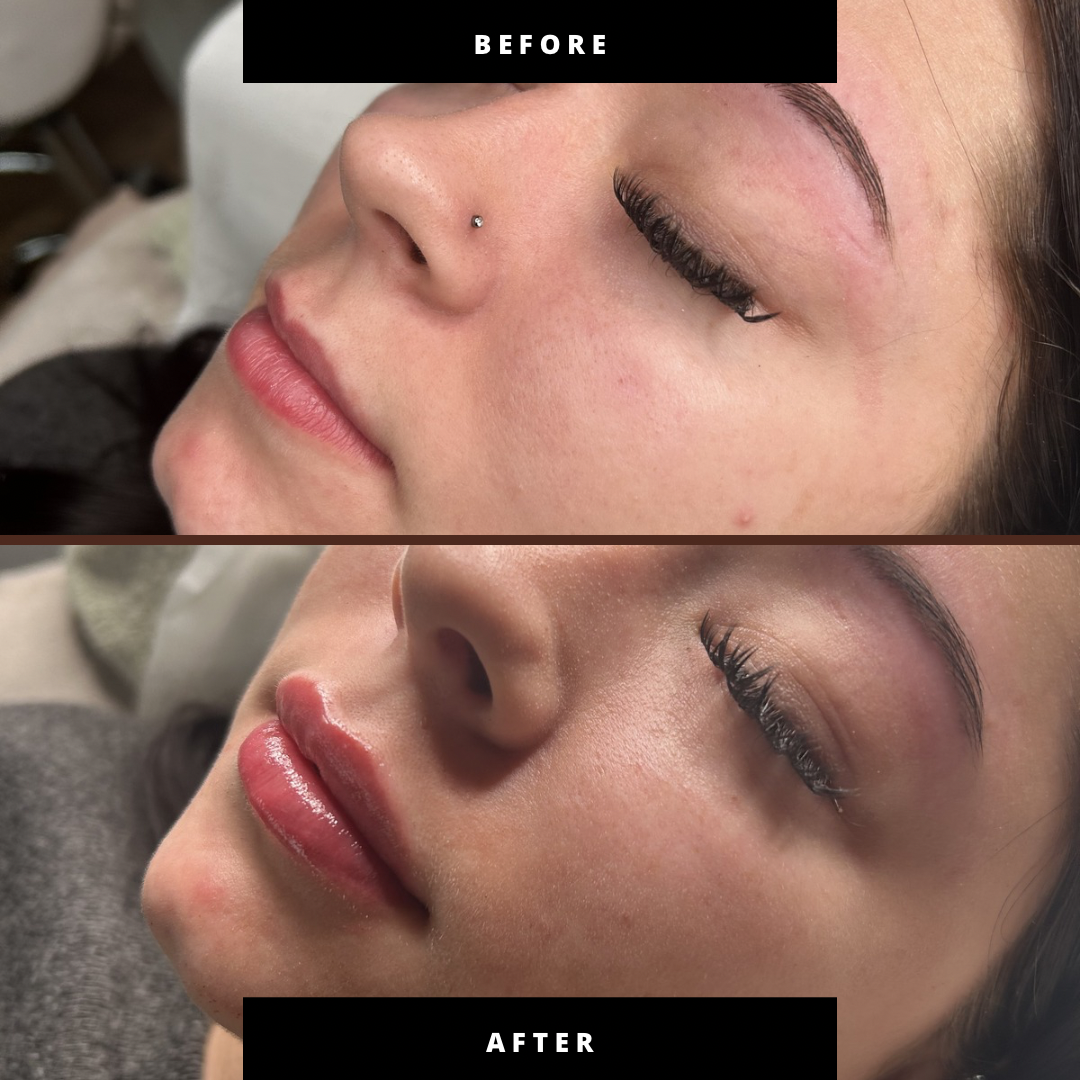 Lip Filler (Augmentation) — before and after results — at Coastal Beauty and Aesthetics Blakeney — Holt