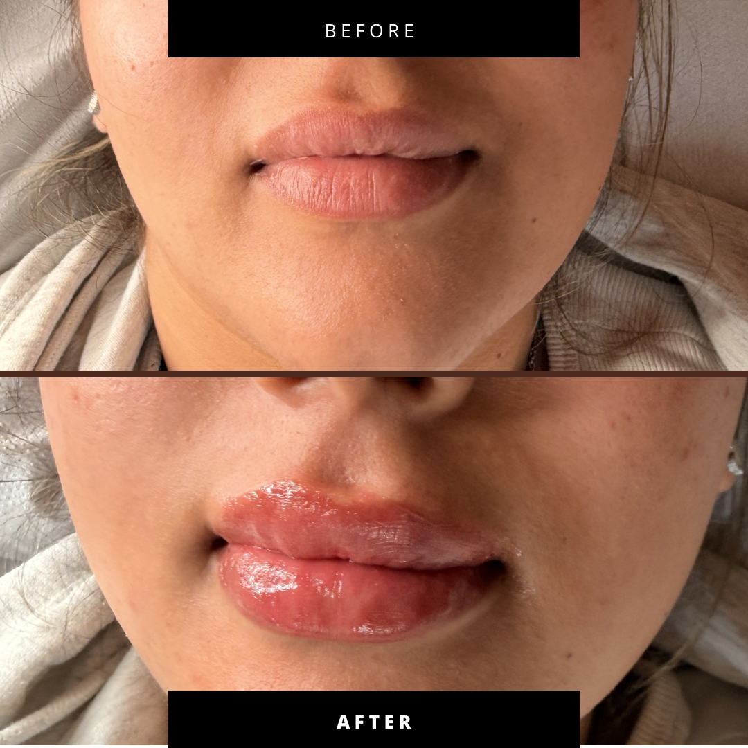 Lip Filler (Augmentation) — before and after results — at Coastal Beauty and Aesthetics Blakeney — Holt
