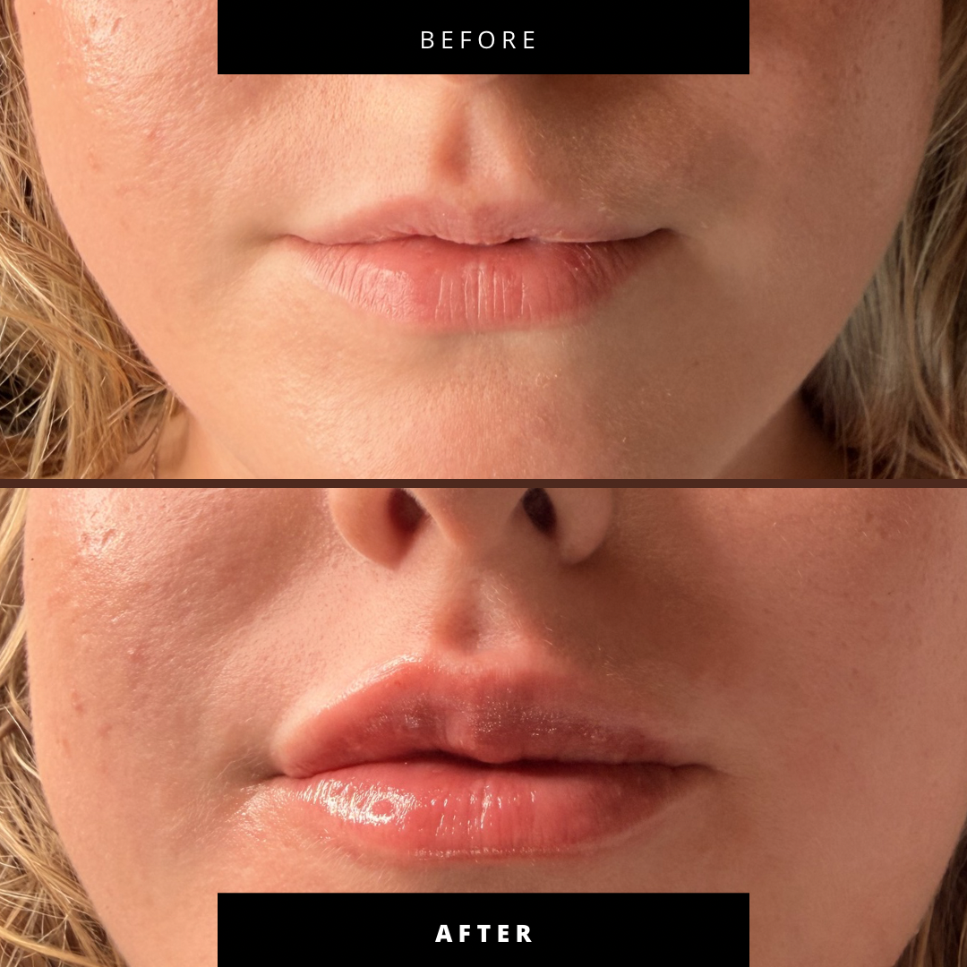 Lip Filler (Augmentation) — before and after results — at Coastal Beauty and Aesthetics Blakeney — Holt