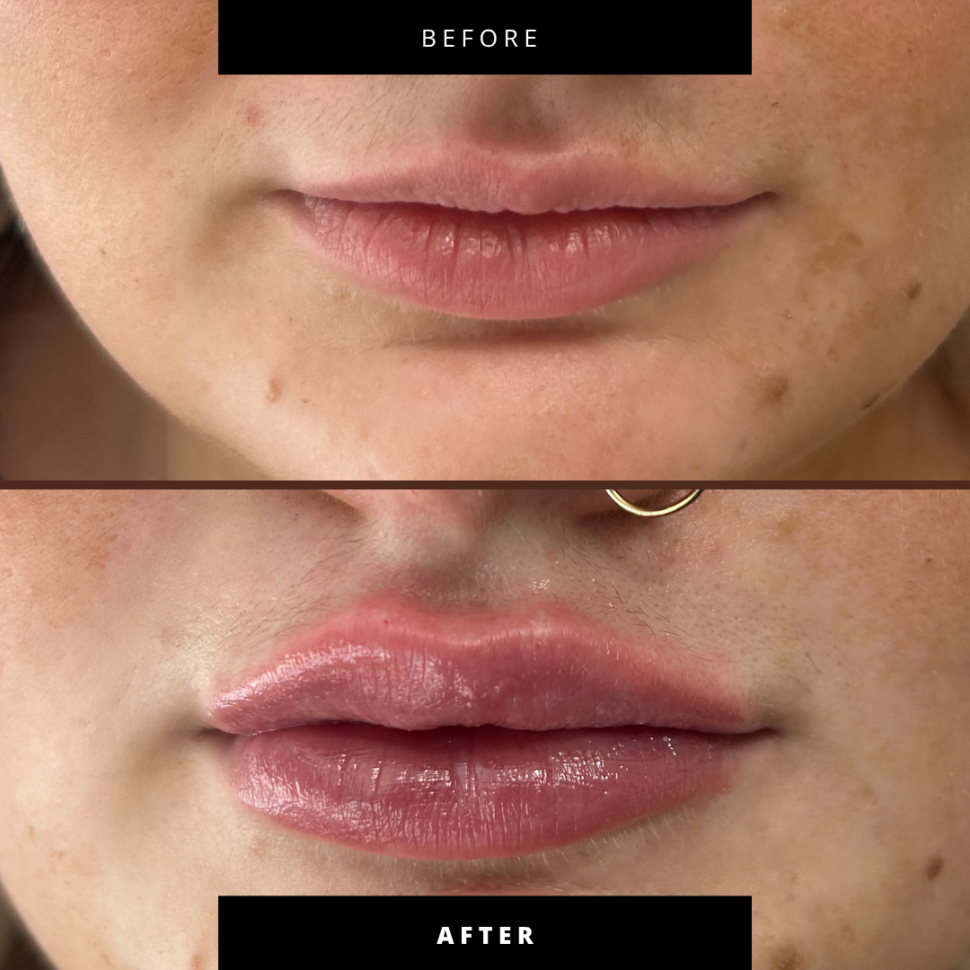 Lip Filler (Augmentation) — before and after results — at Coastal Beauty and Aesthetics Blakeney — Holt