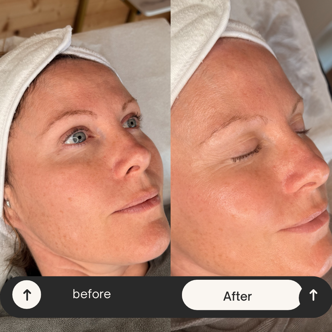 Hydrafacial — before and after results — at Coastal Beauty and Aesthetics Blakeney — Holt