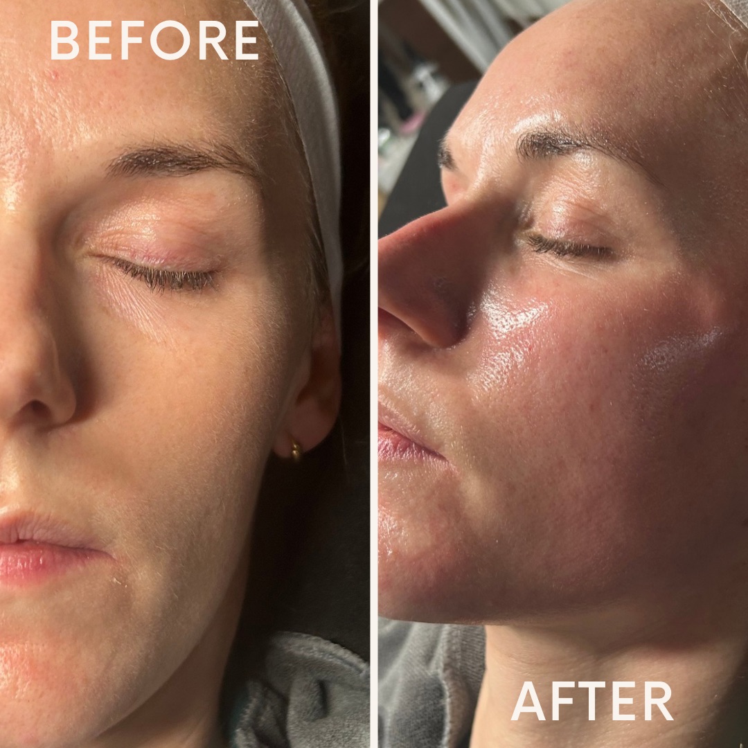 Microneedling — before and after results — at Coastal Beauty and Aesthetics Blakeney — Holt