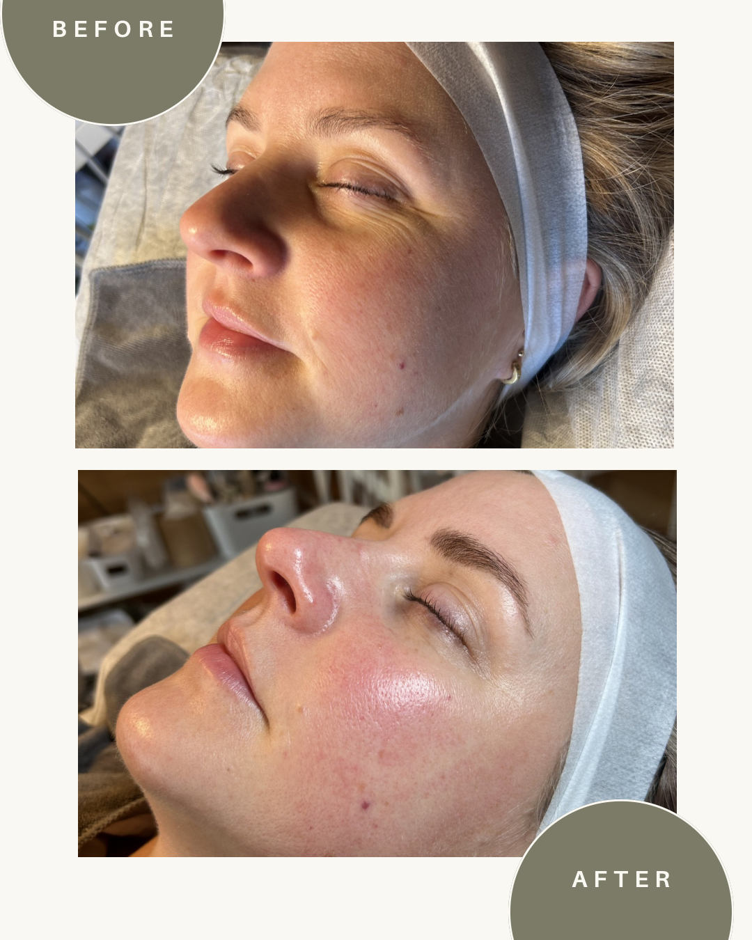 Hydrafacial — before and after results — at Coastal Beauty and Aesthetics Blakeney — Holt