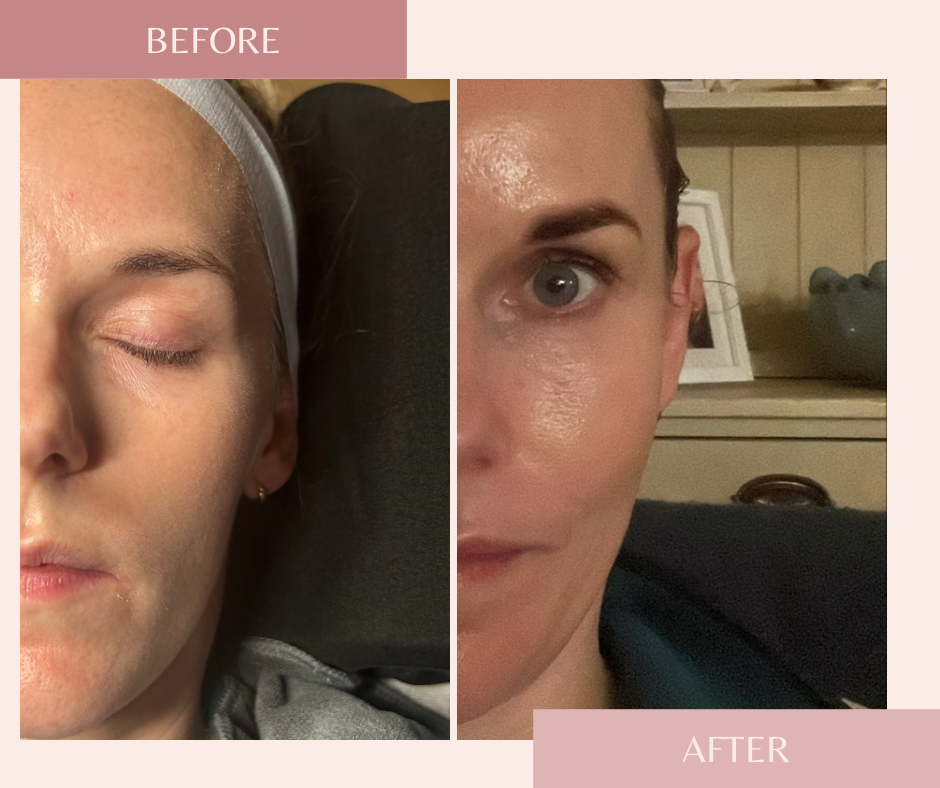 Hydrafacial — before and after results — at Coastal Beauty and Aesthetics Blakeney — Holt