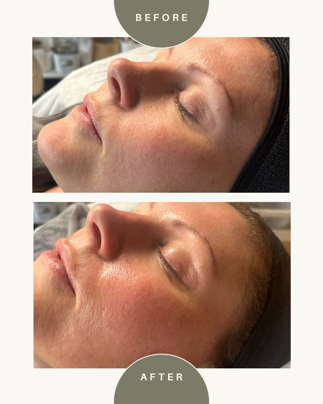 Hydrafacial — before and after results — at Coastal Beauty and Aesthetics Blakeney — Holt