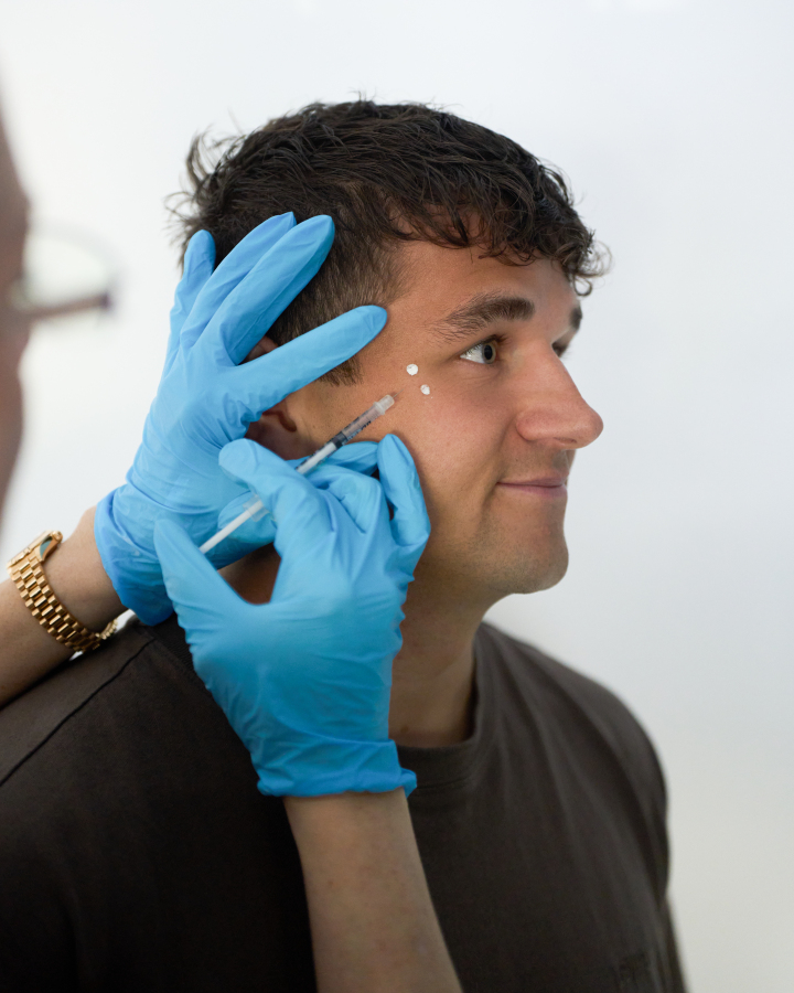 Anti Wrinkle Injections — treatment results — at Thameside Aesthetics — Laleham Village
