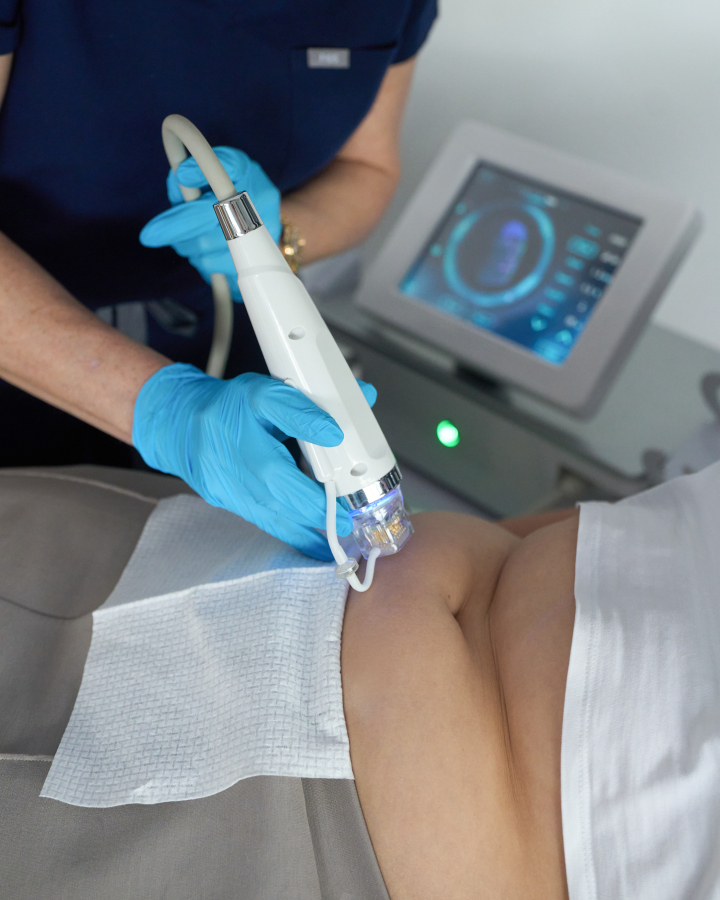 Radio Frequency (RF) — treatment results — at Thameside Aesthetics — Laleham Village