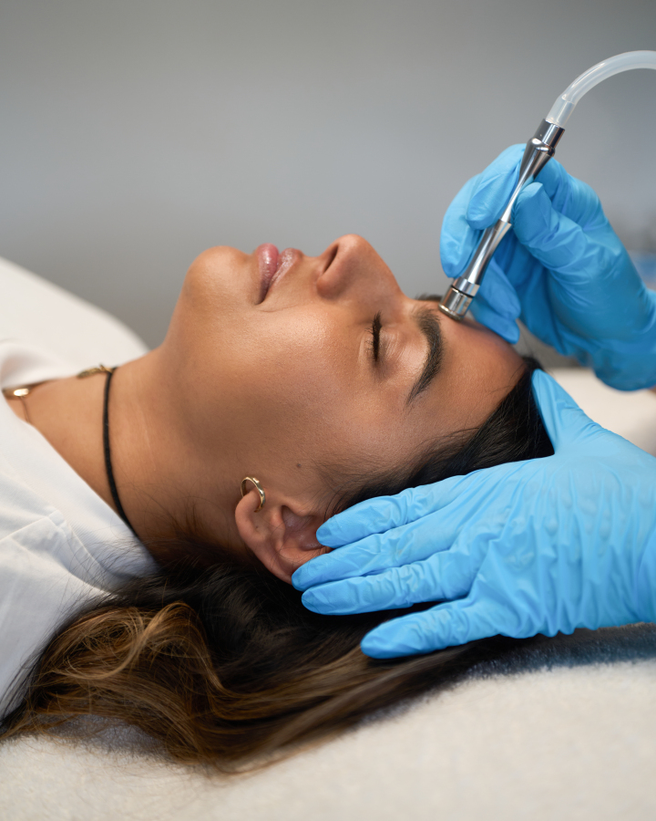 Microdermabrasion — treatment results — at Thameside Aesthetics — Laleham Village