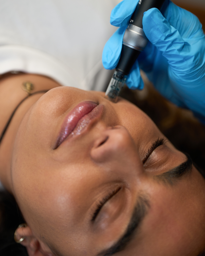 Microneedling — treatment results — at Thameside Aesthetics — Laleham Village