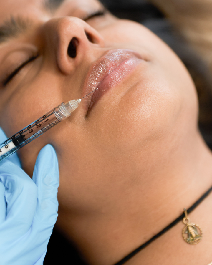 Lip Filler (Augmentation) — treatment results — at Thameside Aesthetics — Laleham Village