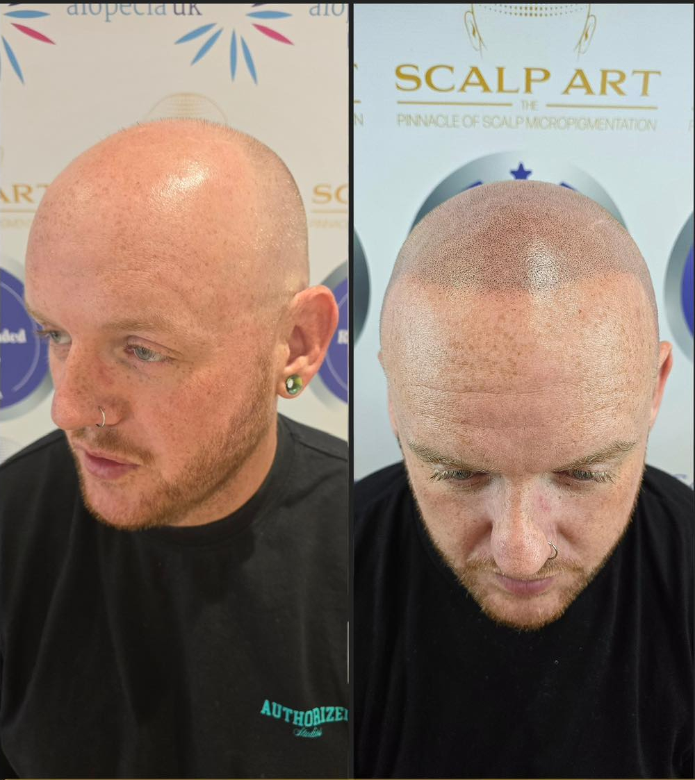 Scalp Micropigmentation (SMP) — before and after results — at Scalp Art Clinic — Chelmsford