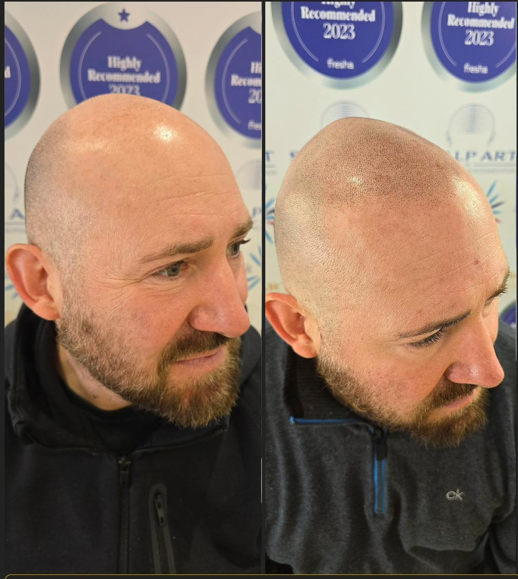 hair tattoo (SMP) — treatment results — at Scalp Art Clinic — Essex