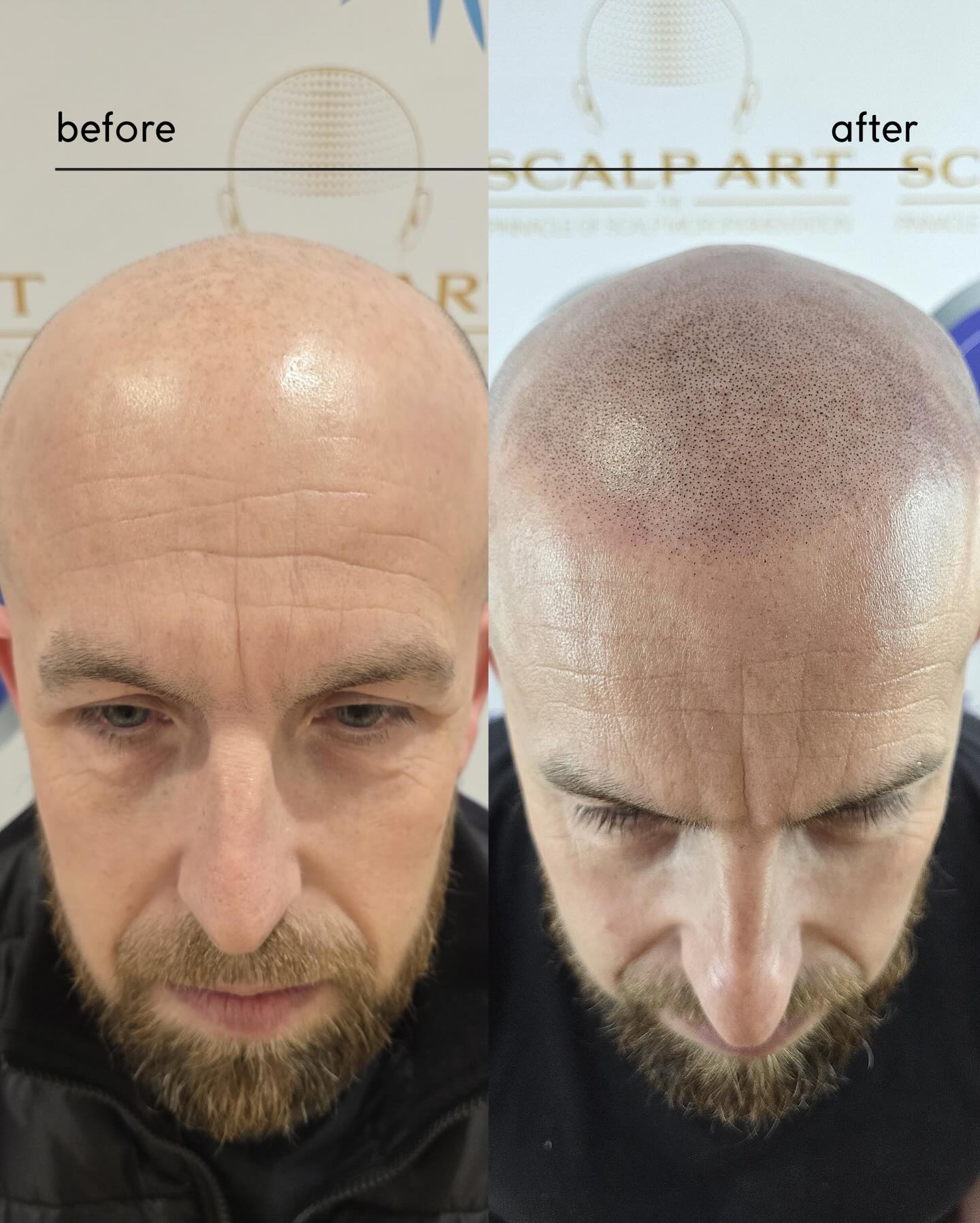 Scalp Micropigmentation (SMP) — treatment results — at Scalp Art Clinic — Chelmsford, Essex, UK