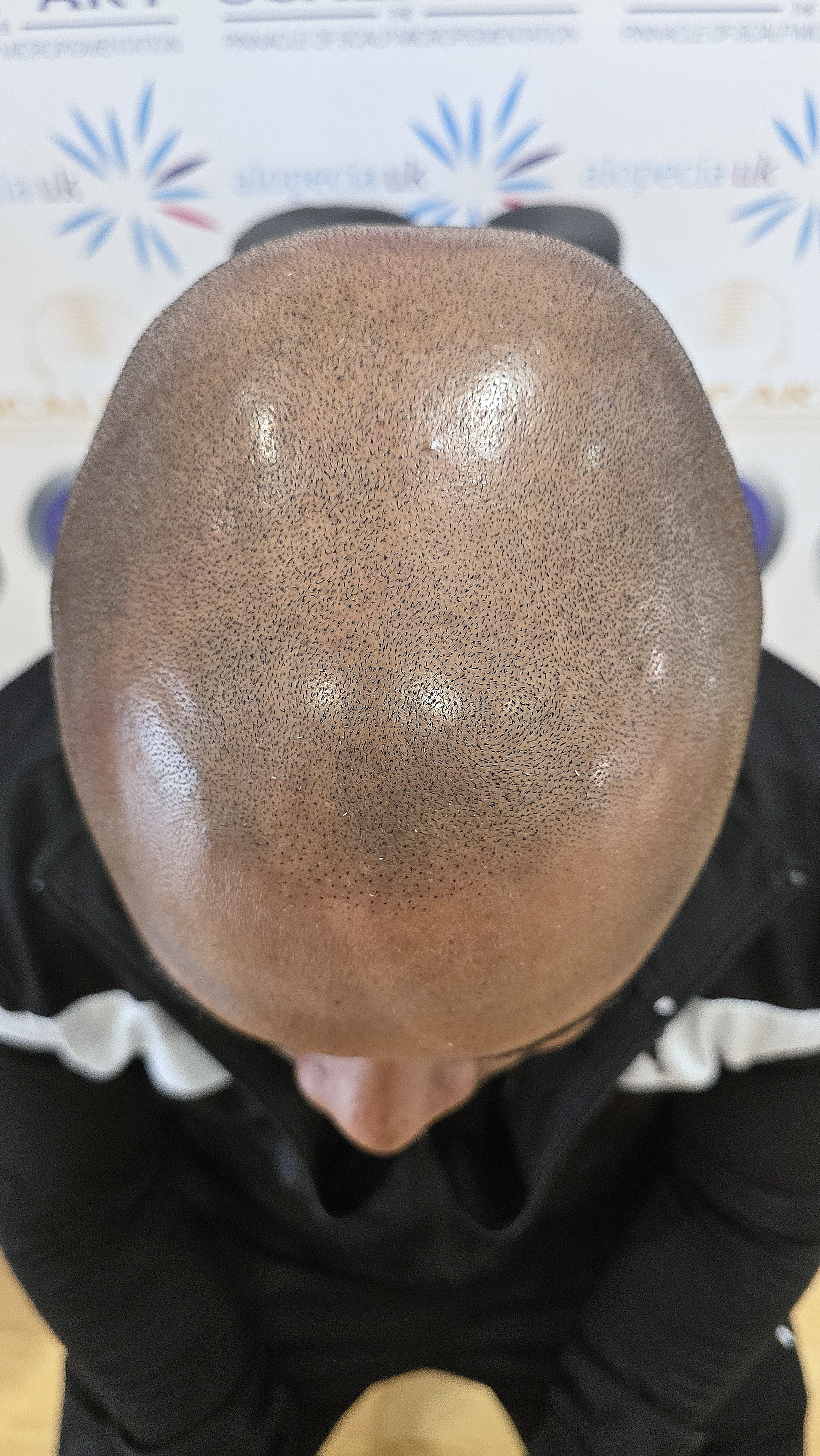 Scalp Micropigmentation (SMP) — treatment results — at Scalp Art Clinic — Chelmsford