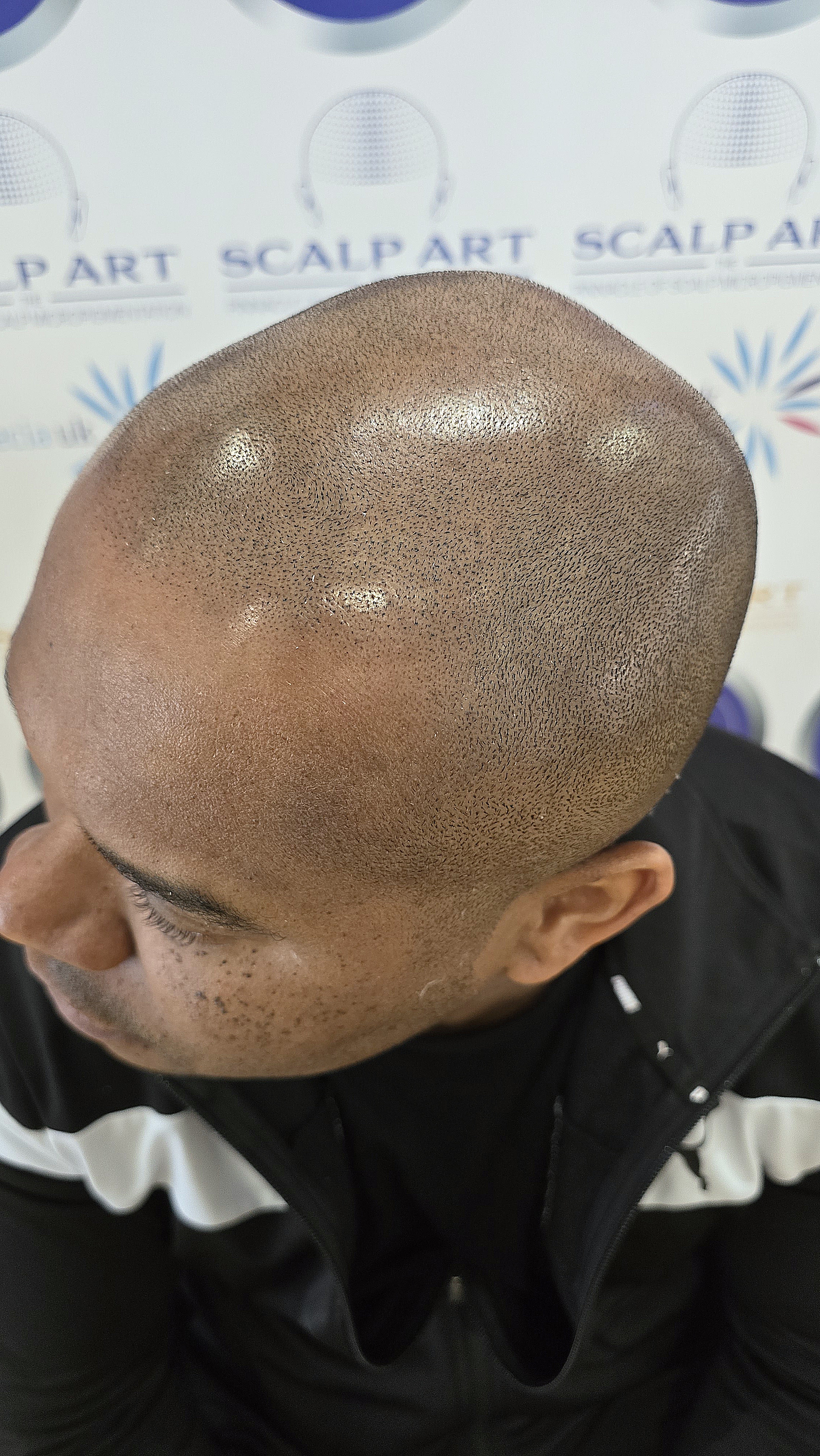 Scalp Micropigmentation (SMP) — treatment results — at Scalp Art Clinic — Chelmsford