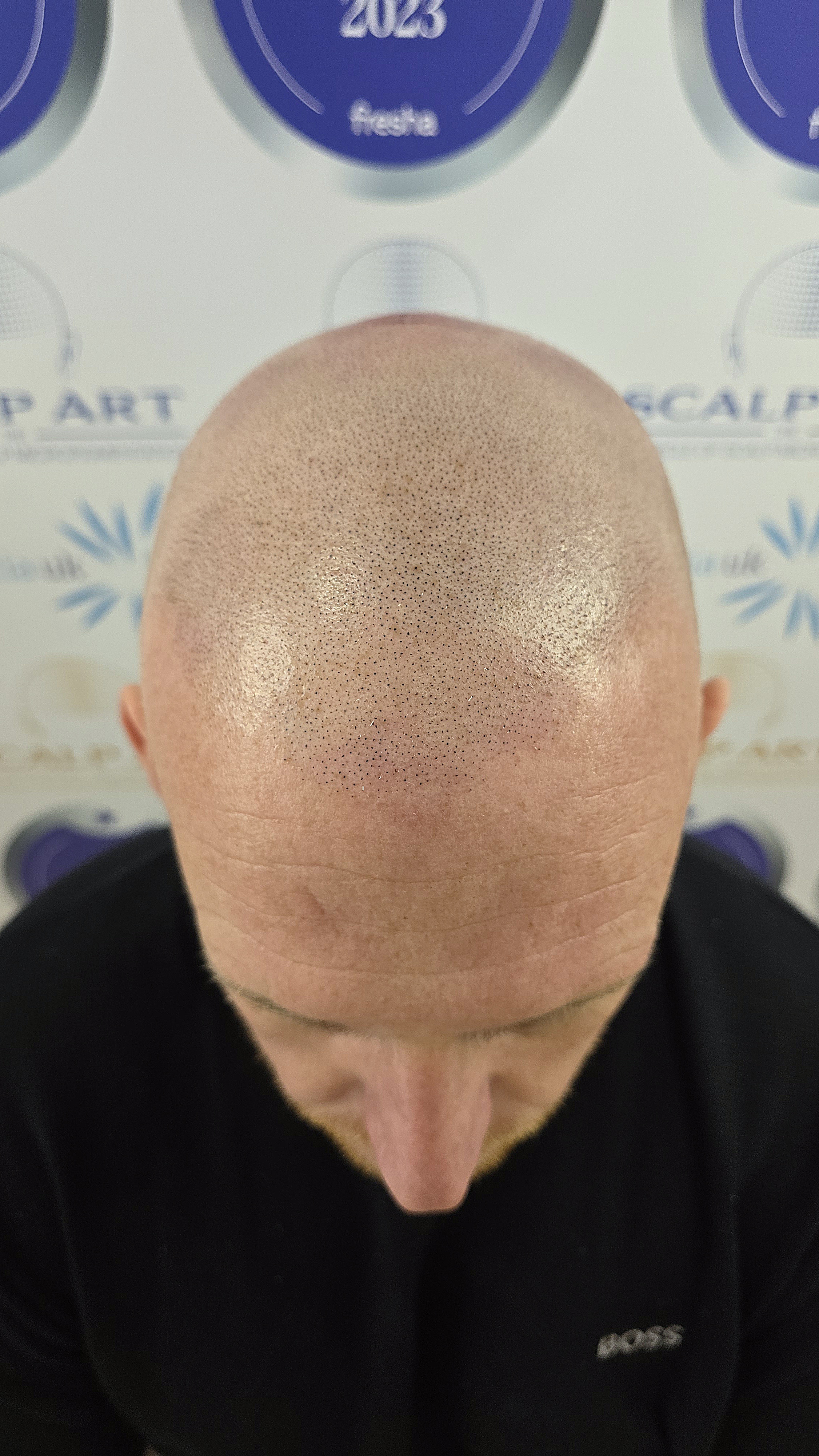 Scalp Micropigmentation (SMP) — treatment results — at Scalp Art Clinic — Chelmsford