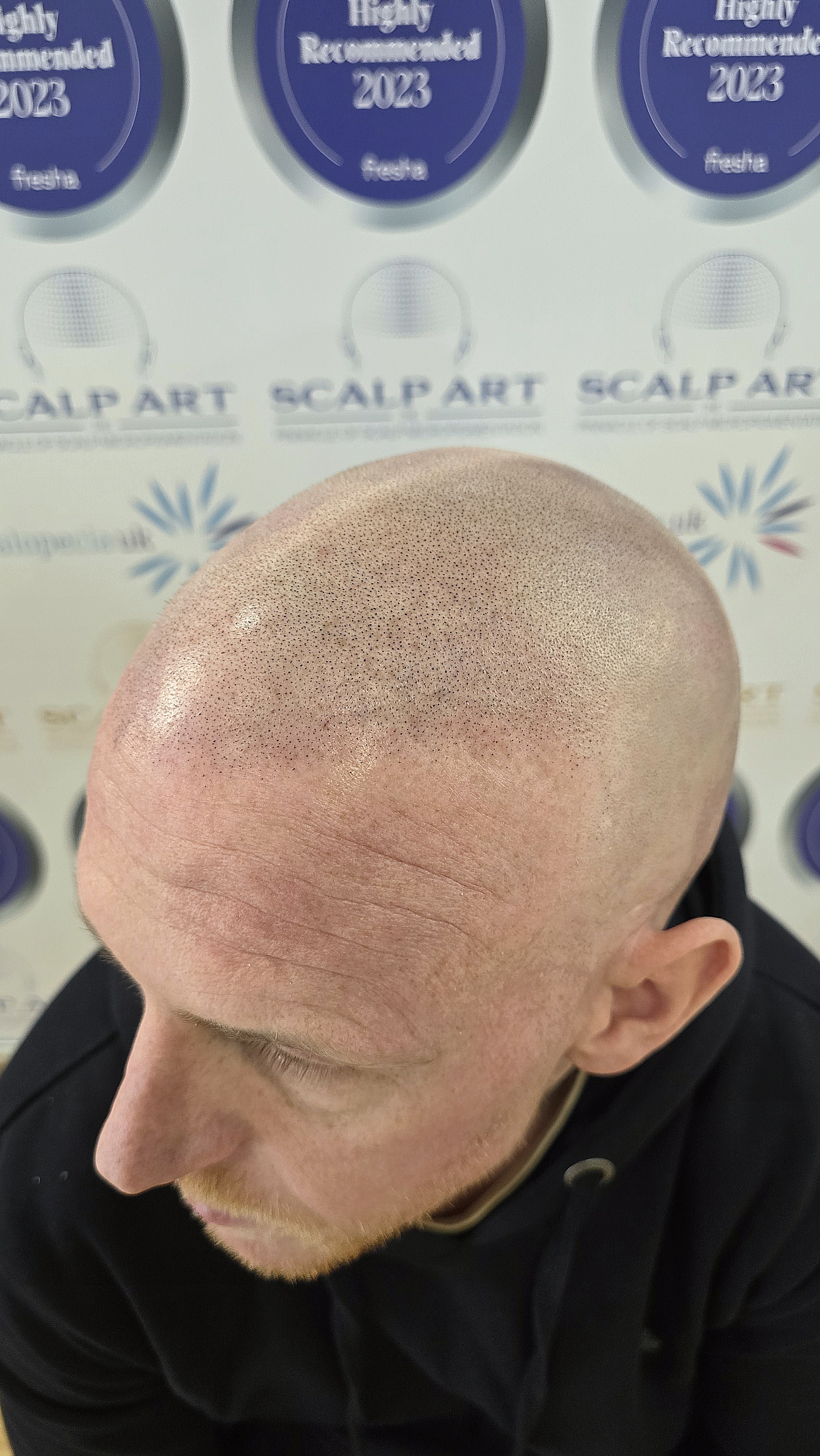 Scalp Micropigmentation (SMP) — treatment results — at Scalp Art Clinic — Chelmsford