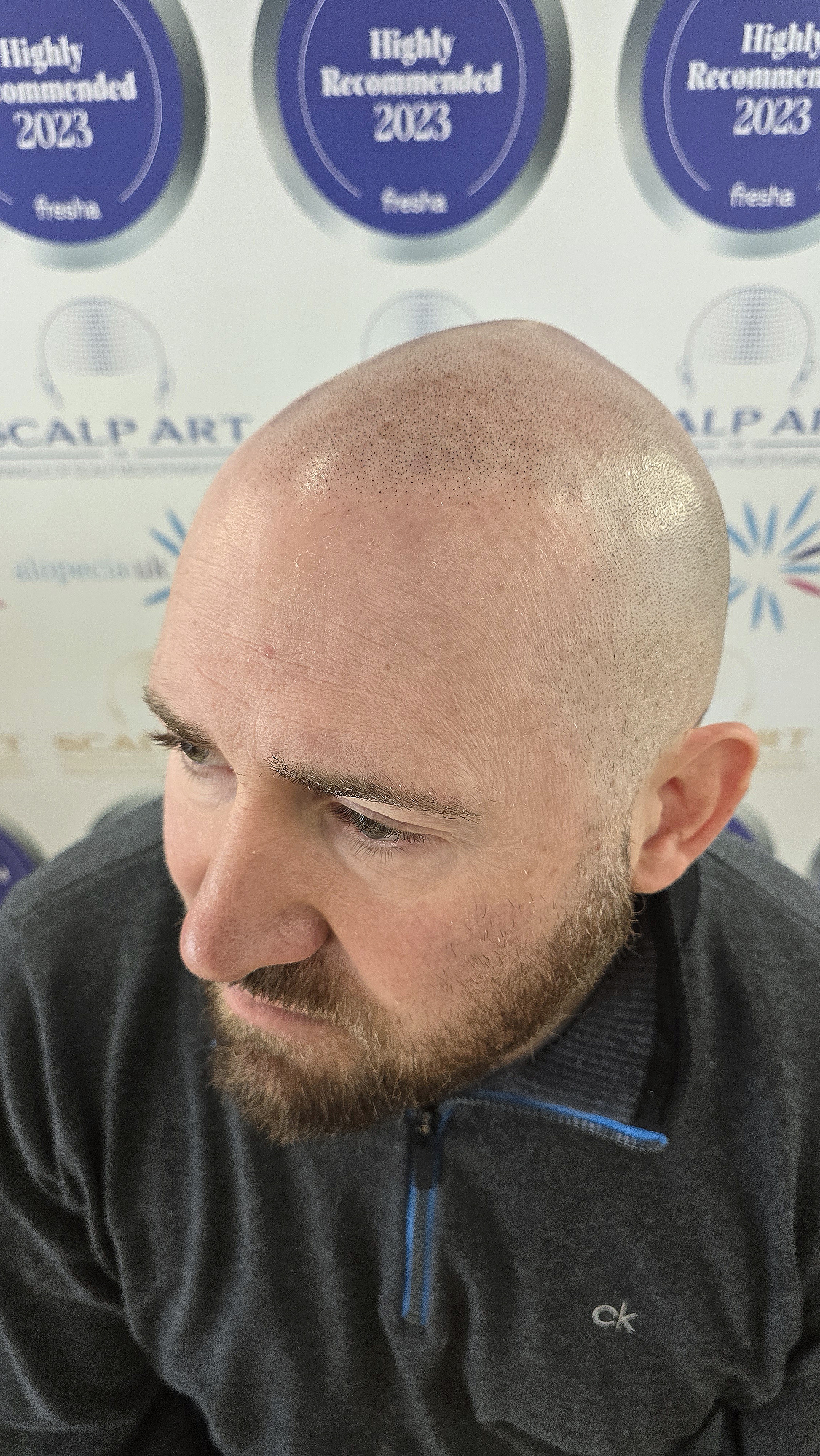 Scalp Micropigmentation (SMP) — treatment results — at Scalp Art Clinic — Chelmsford